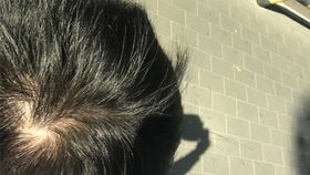 女童突然脱发眼神呆滞，查明原因竟是铊中毒！